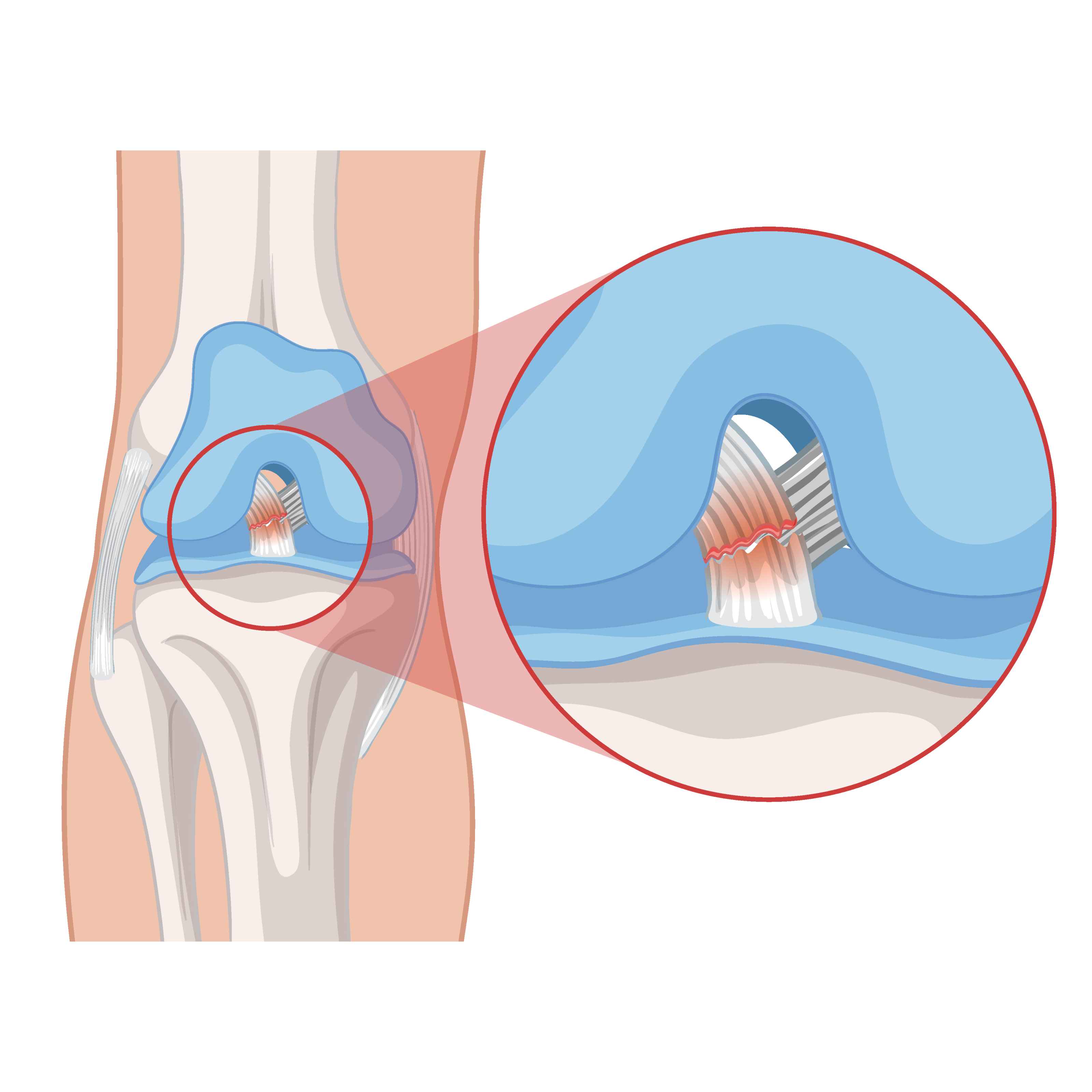 ACL Tear