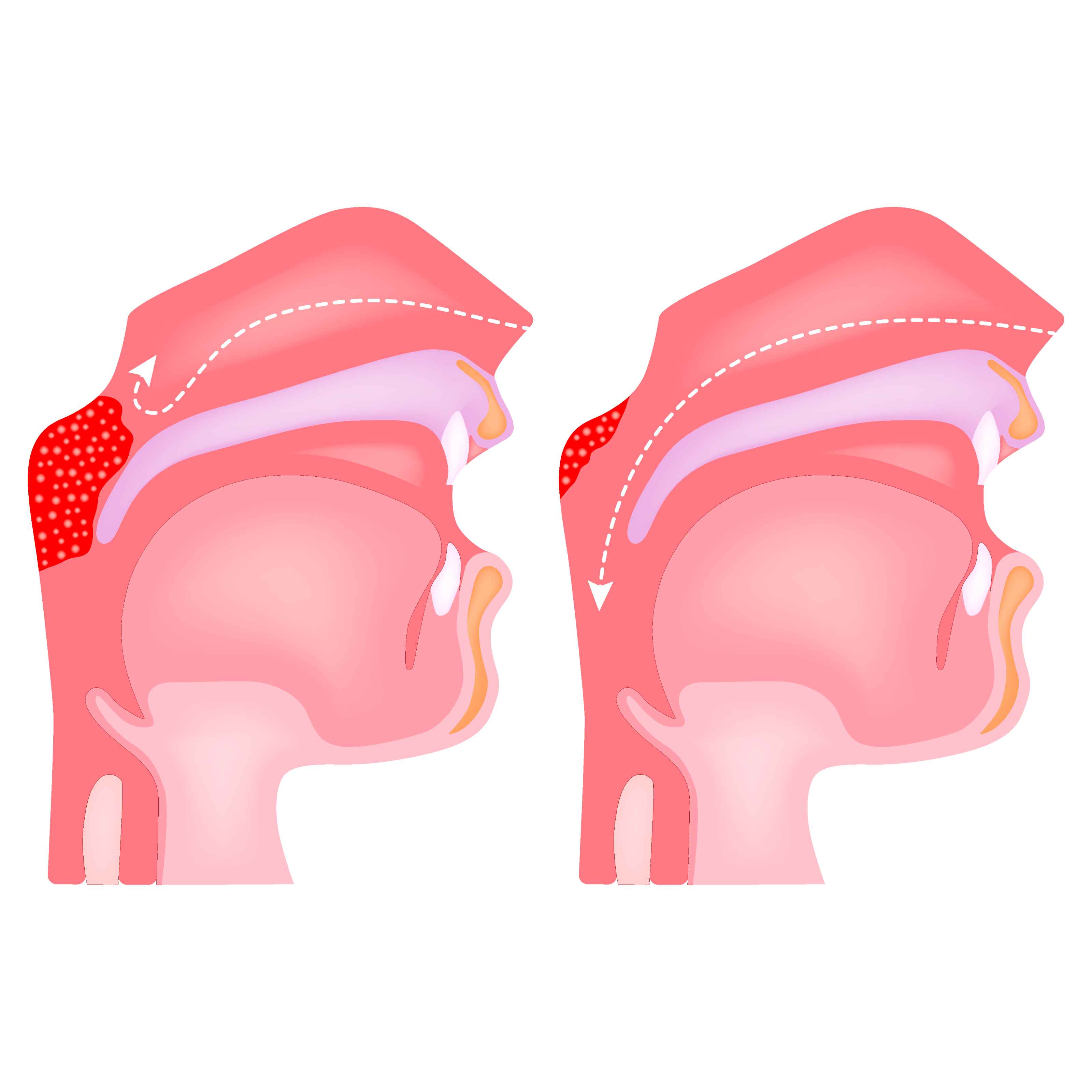 Adenoidectomy