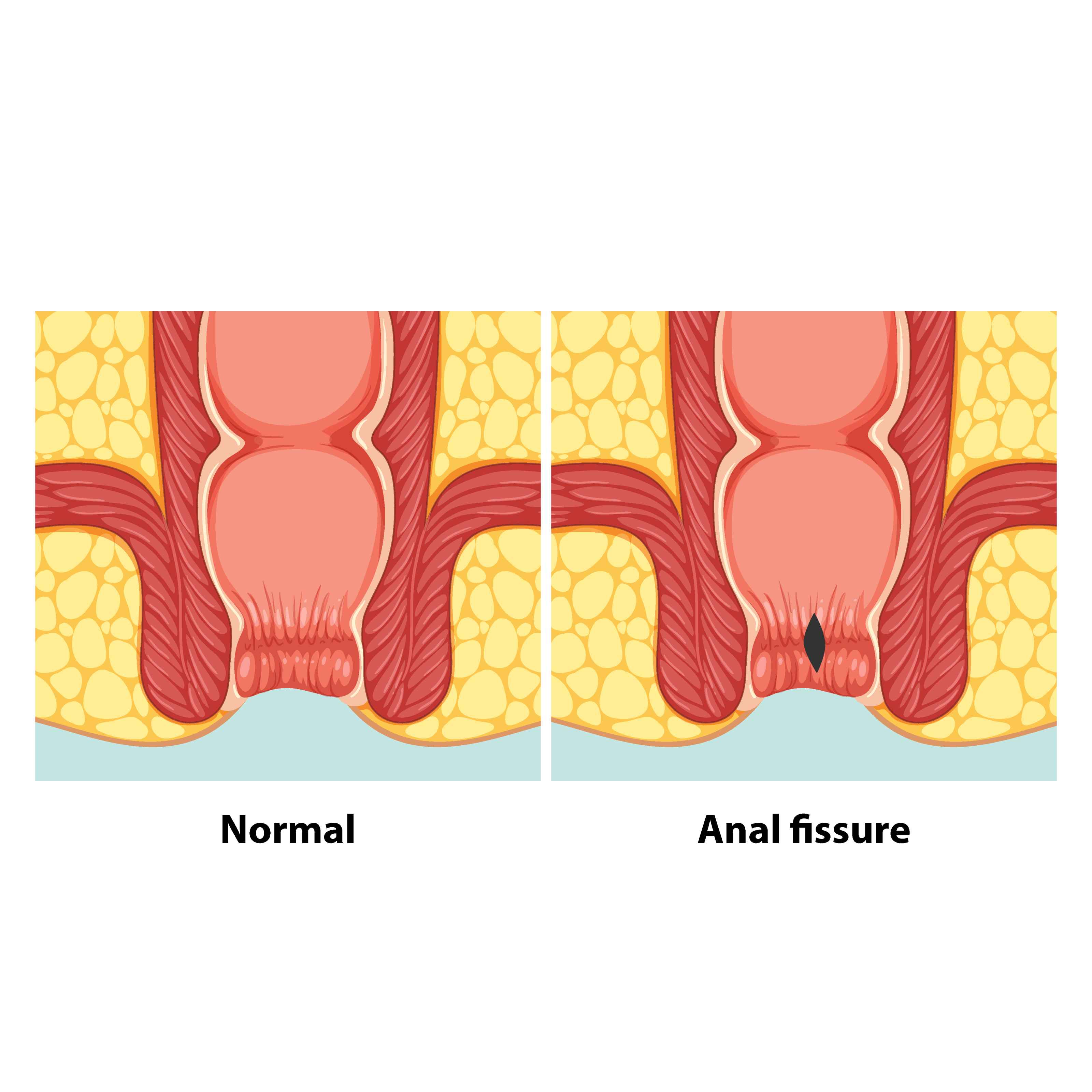 Anal Fissure