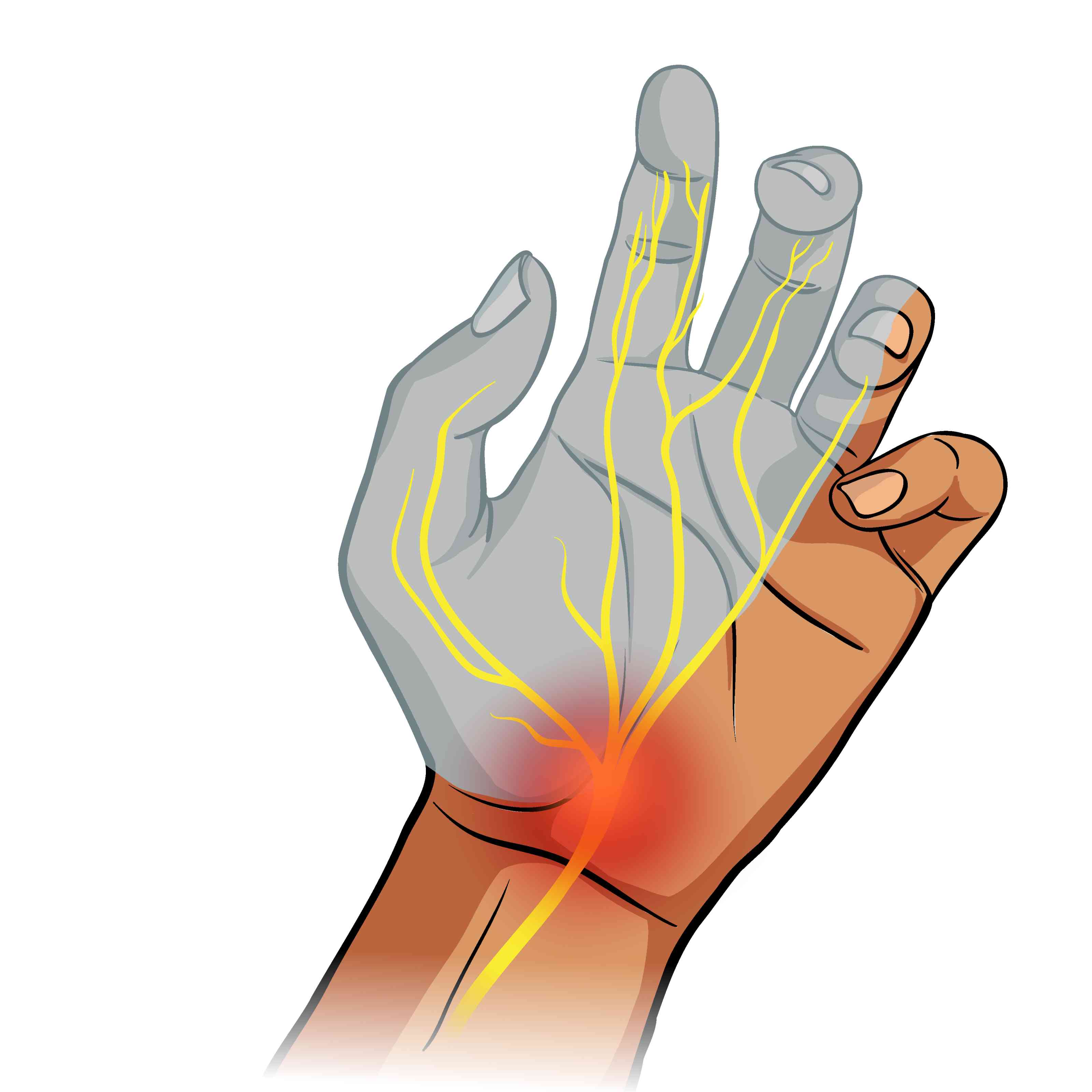 Carpal Tunnel Syndrome