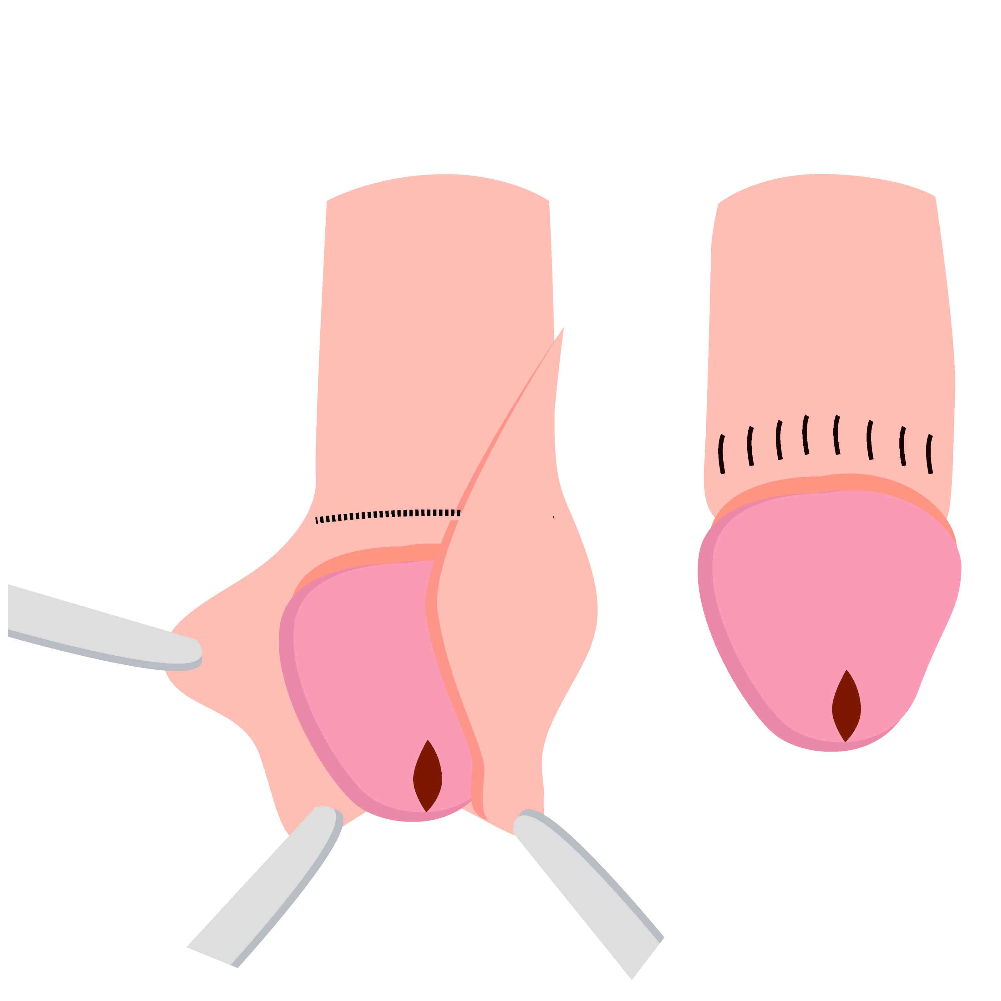 Circumcision