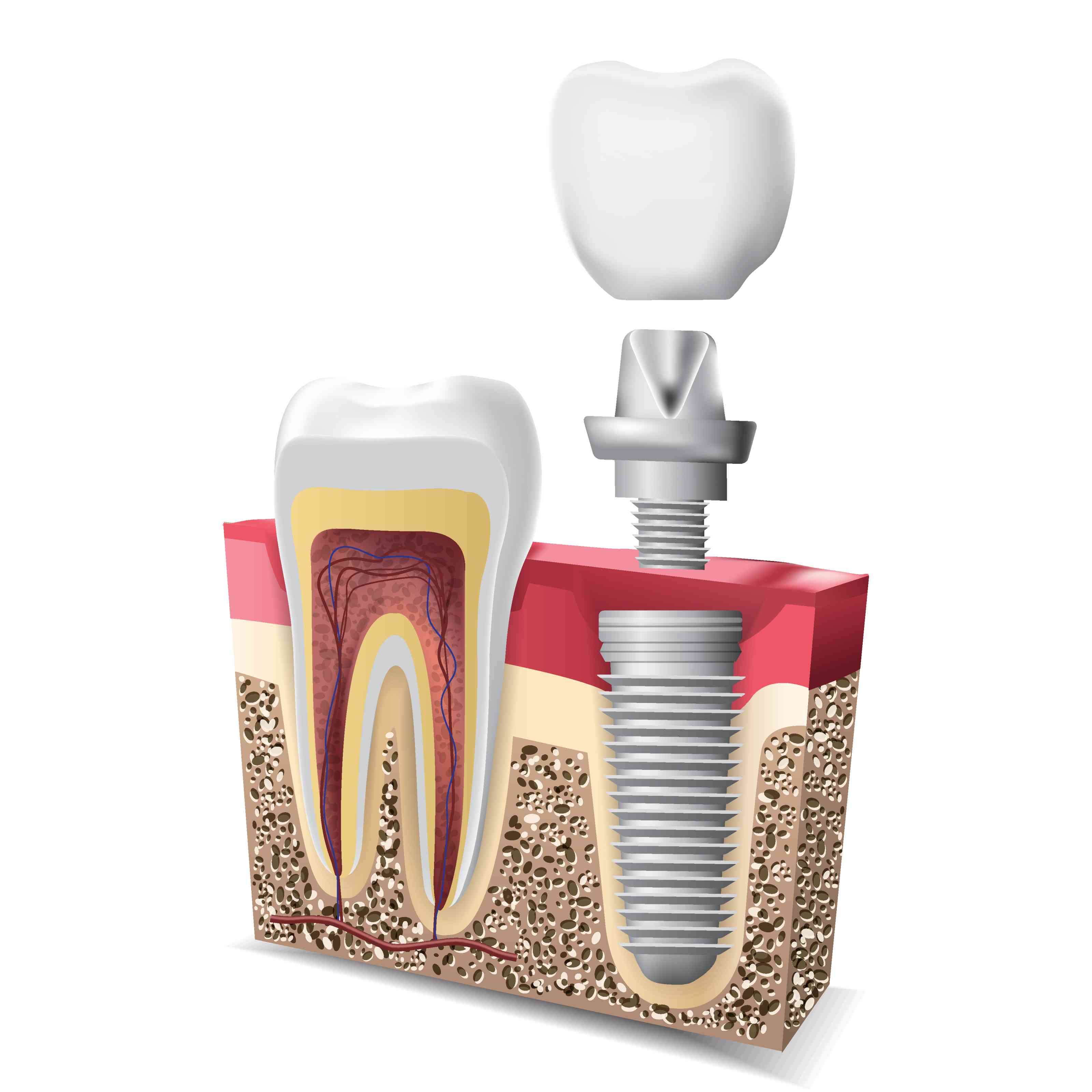 Dental Implant