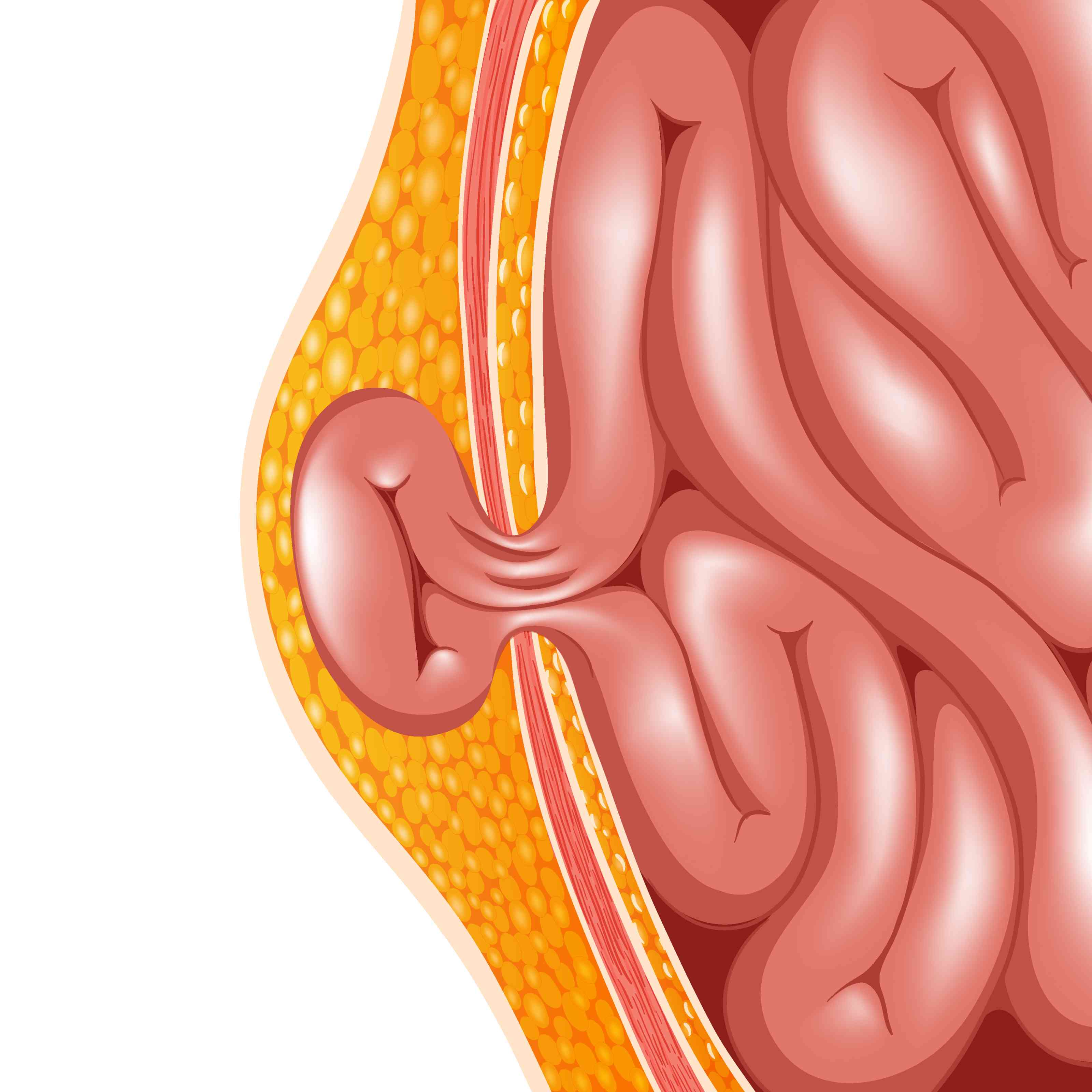Hernia Surgery