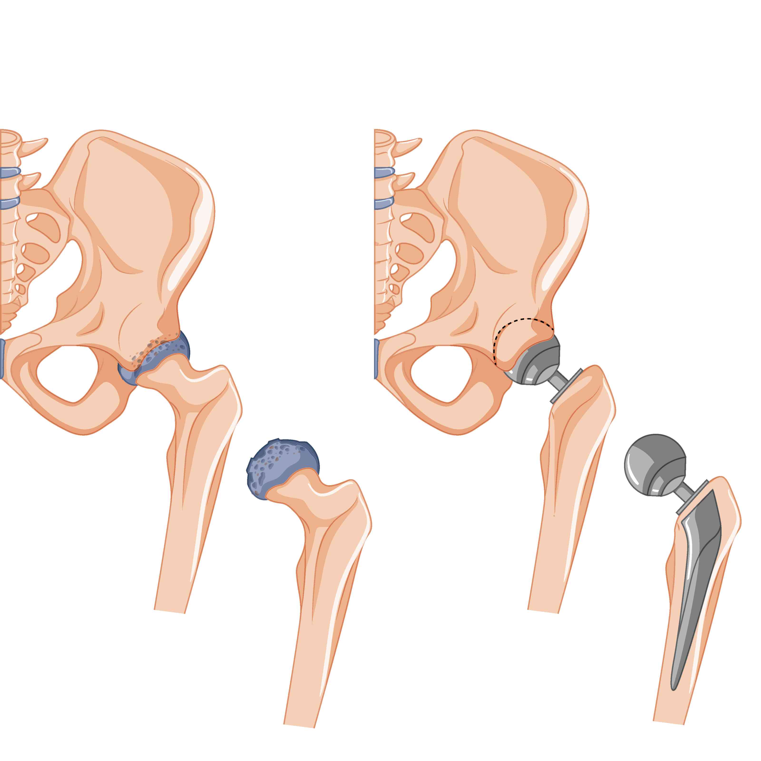 Hip Replacement