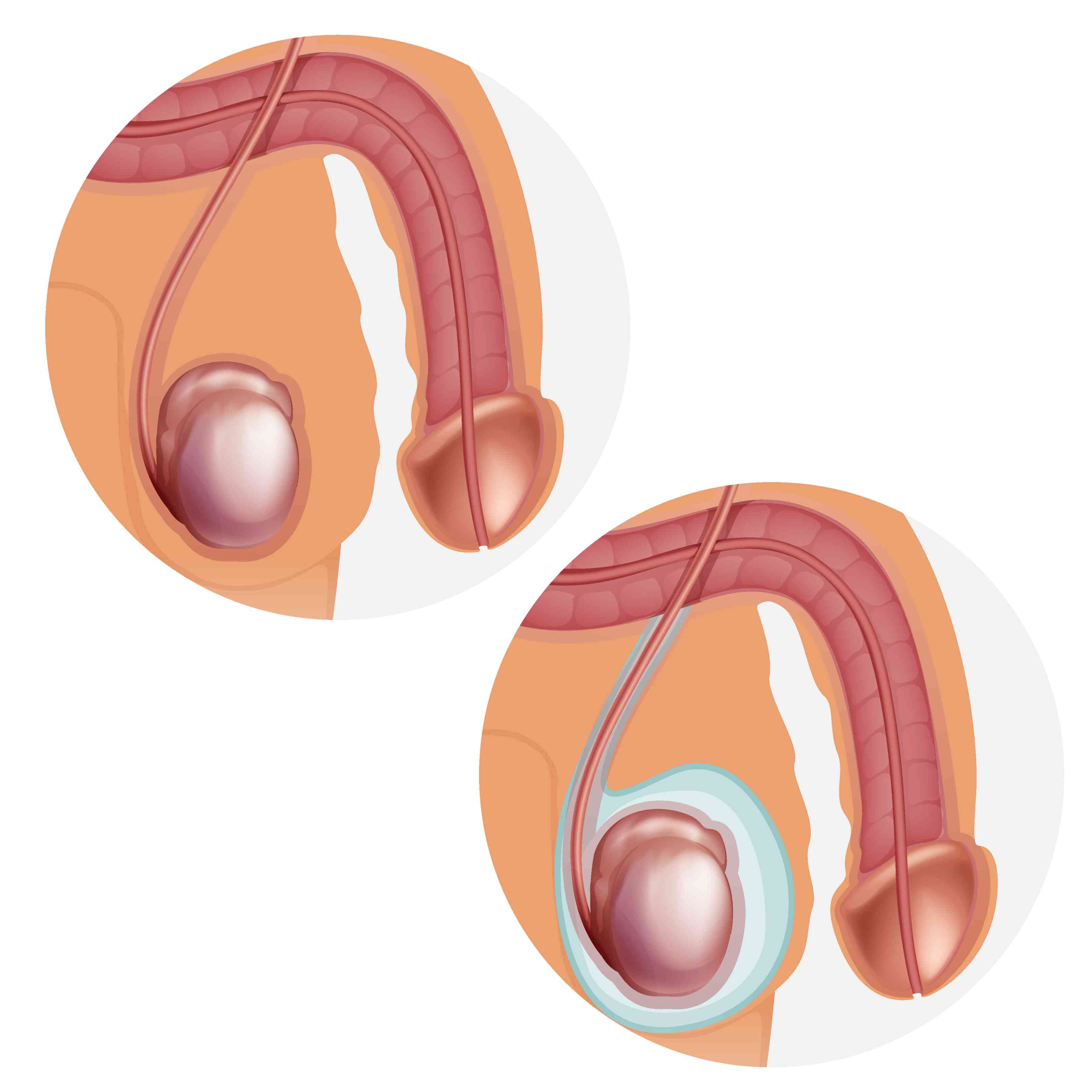 Hydrocele Treatment