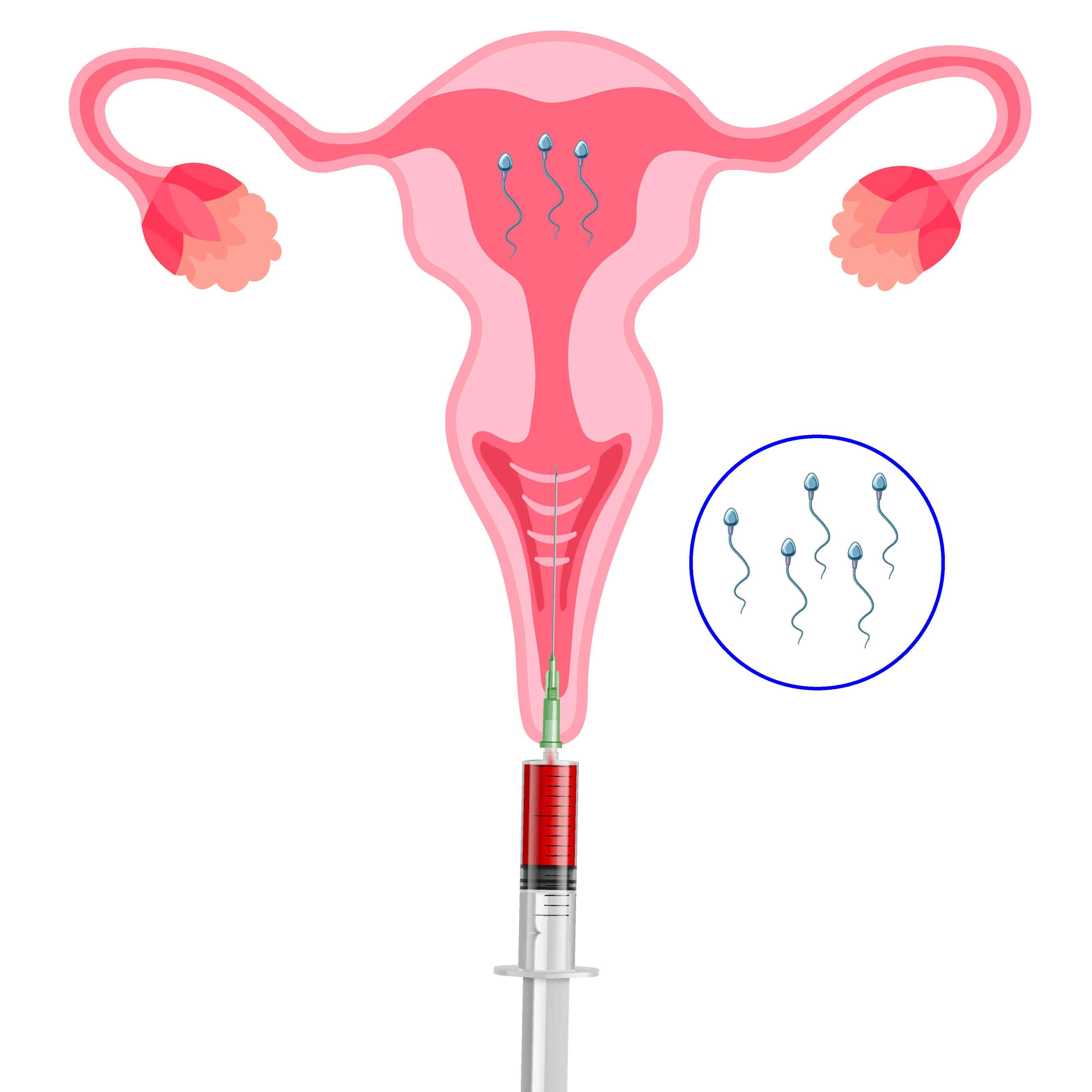 IUI