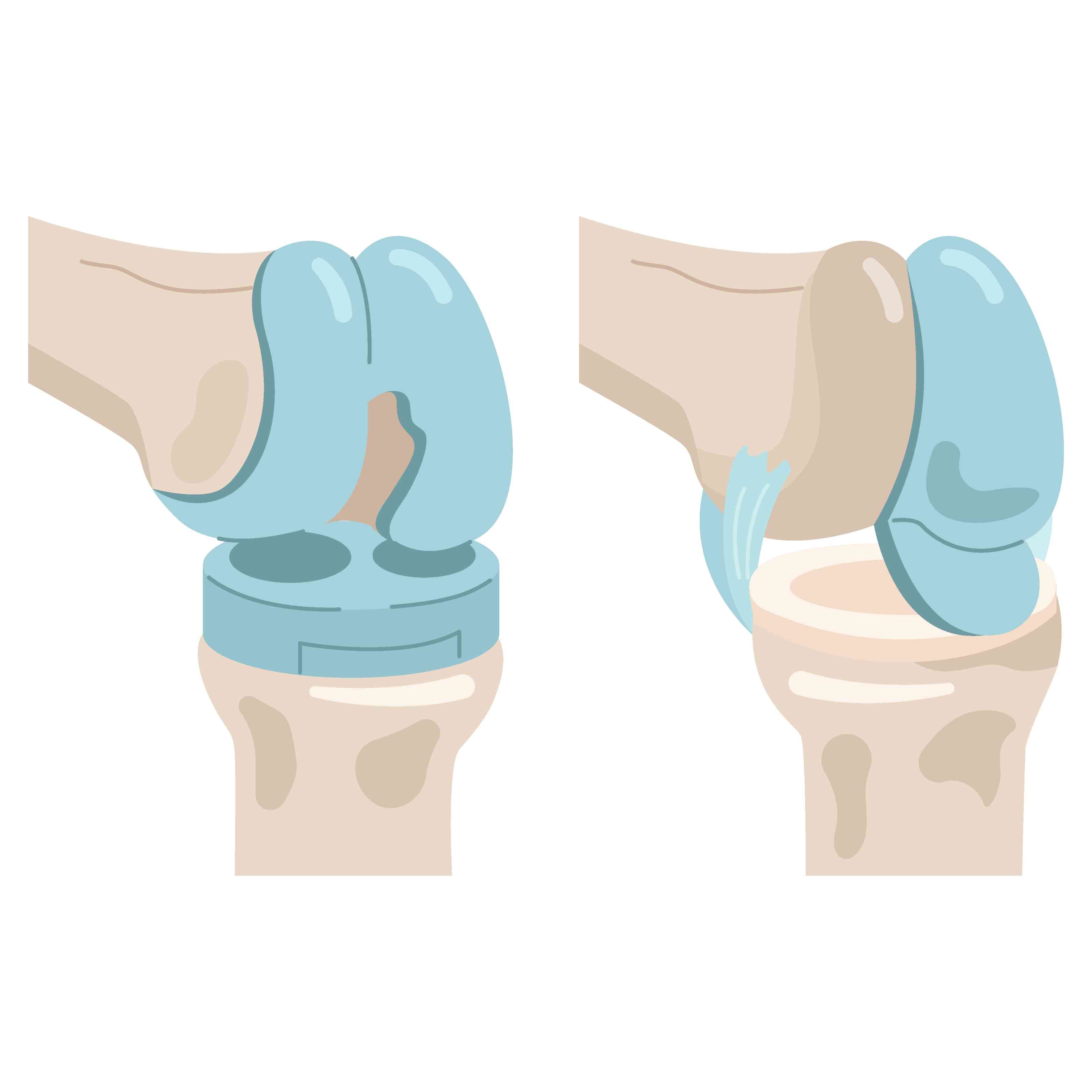 Knee Replacement
