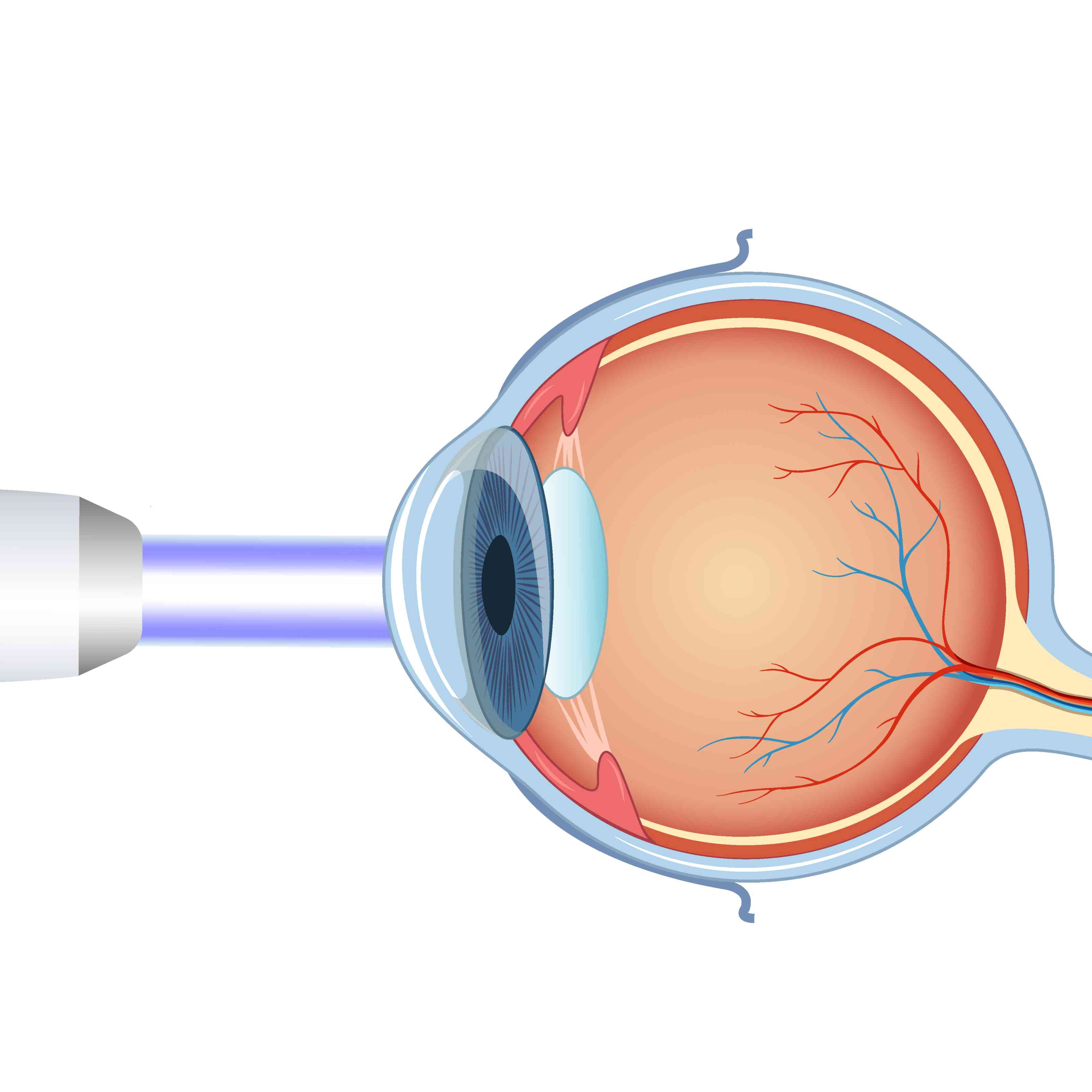 Lasik Surgery