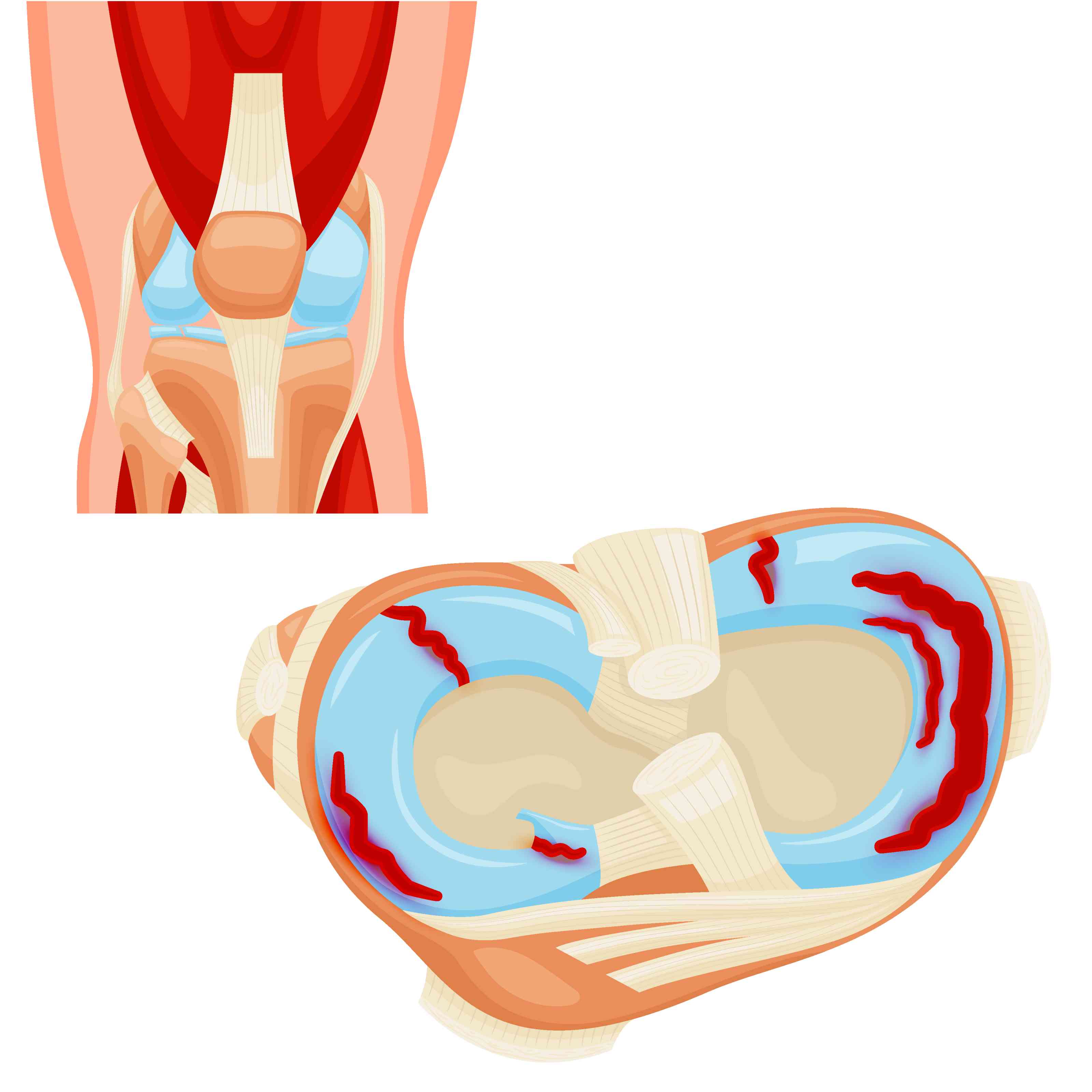 Meniscus Tear