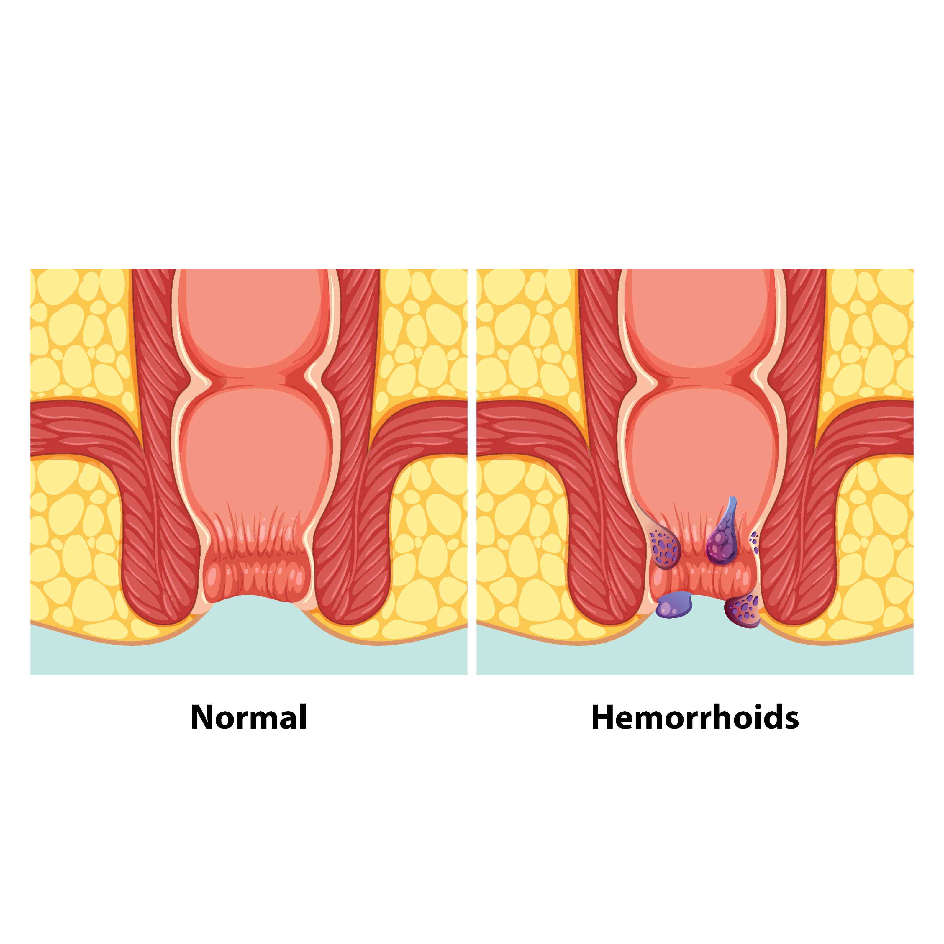 Piles/Hemorrhoids