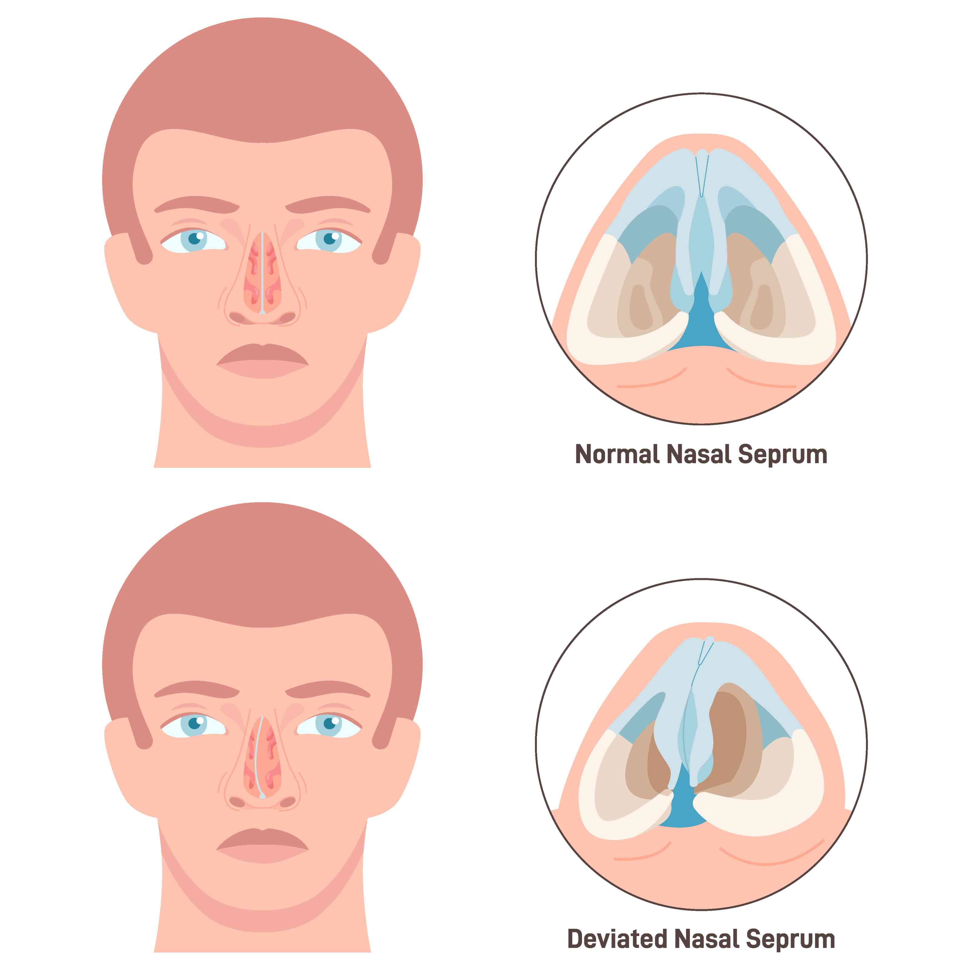 Septoplasty