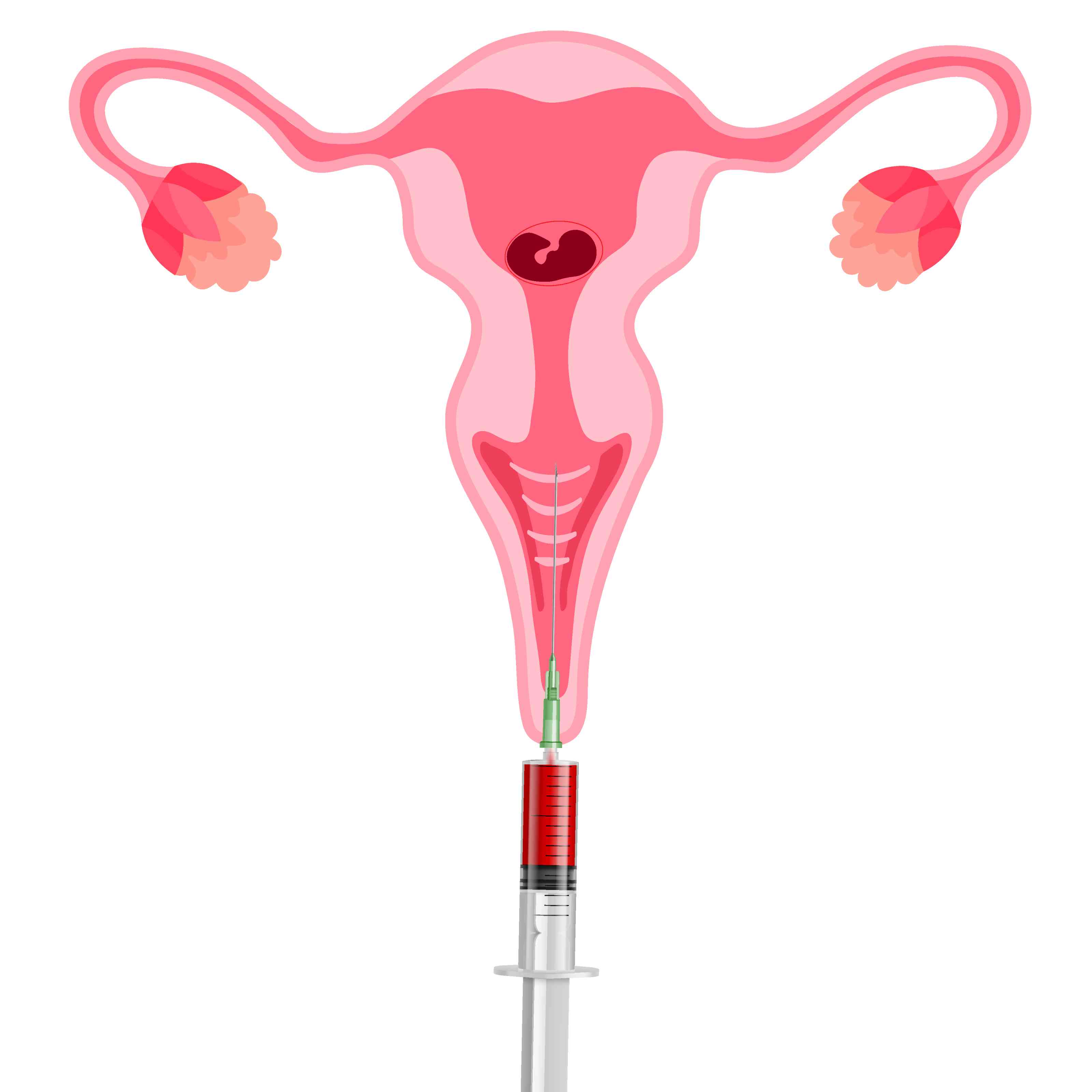 Surgical Abortion