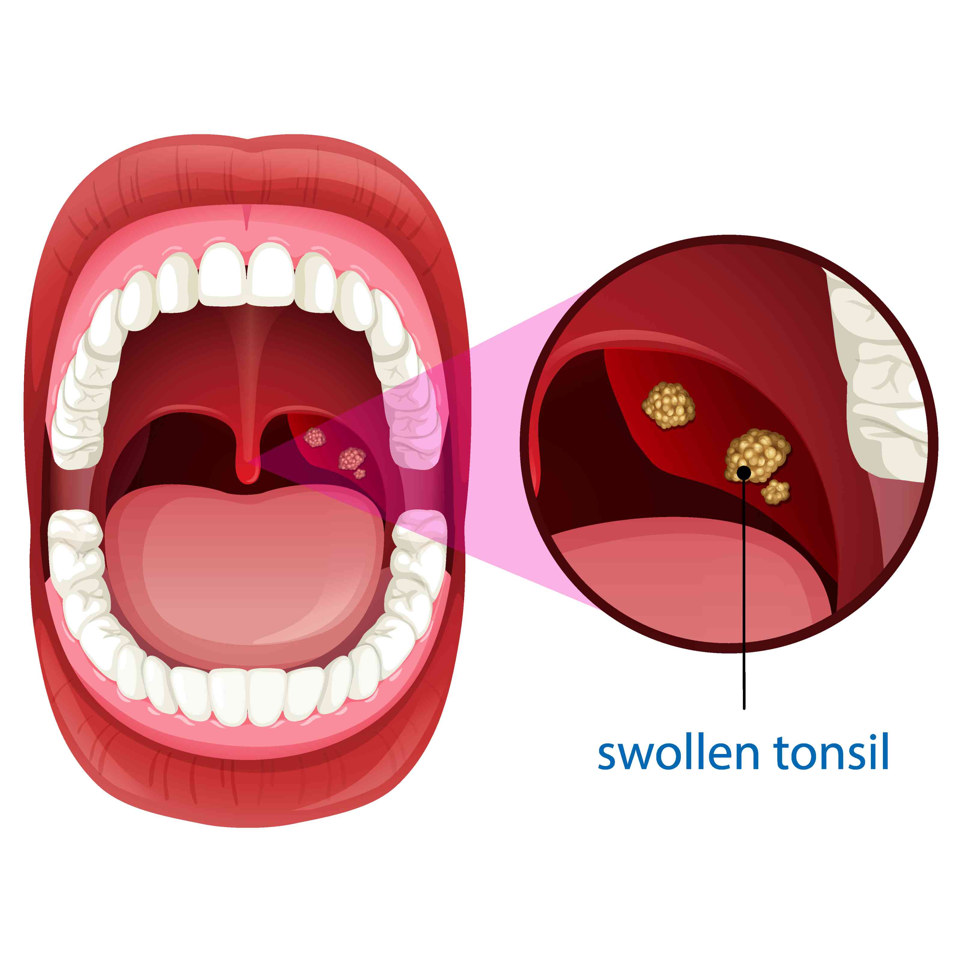 Tonsillectomy