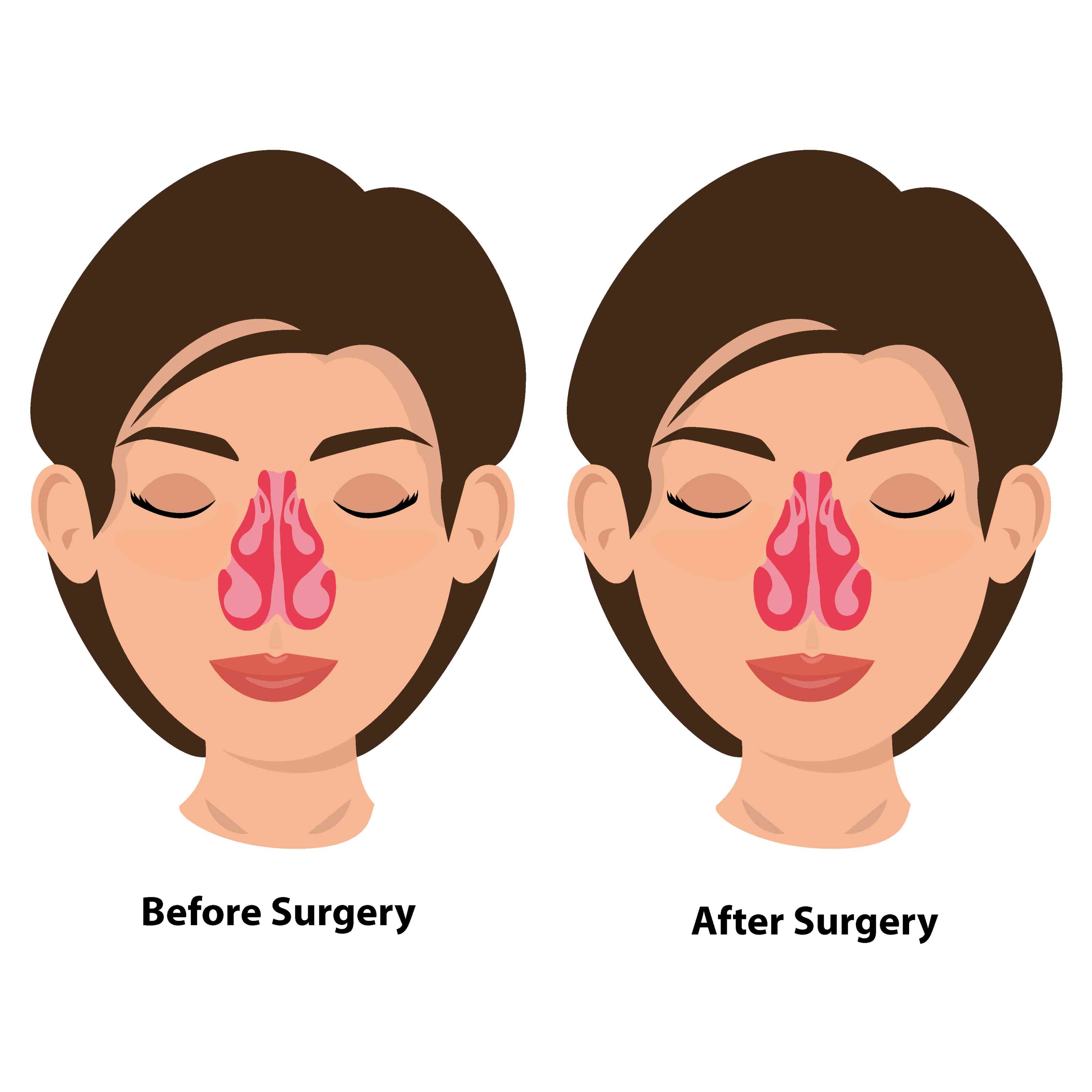 Turbinoplasty