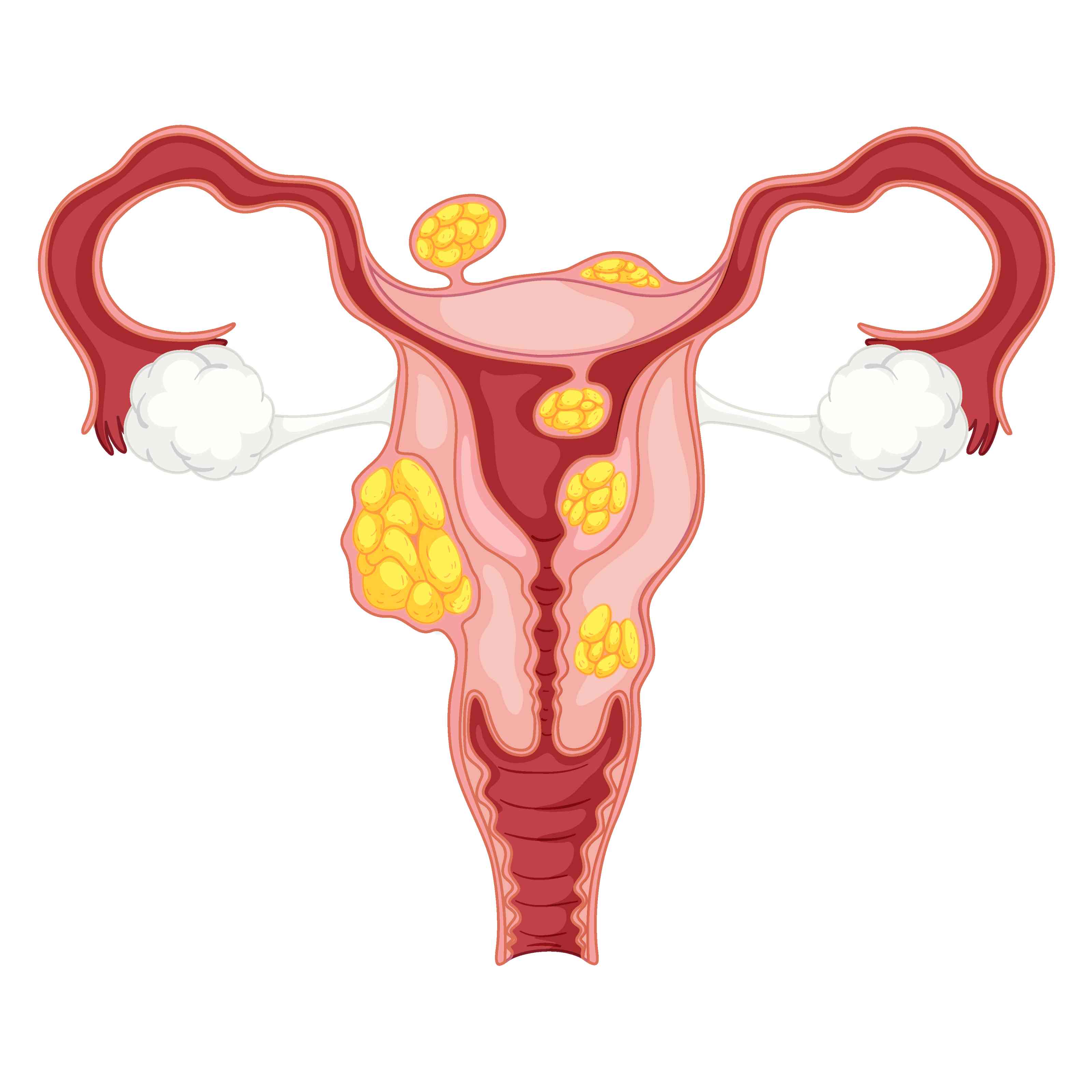 Uterine Fibroid