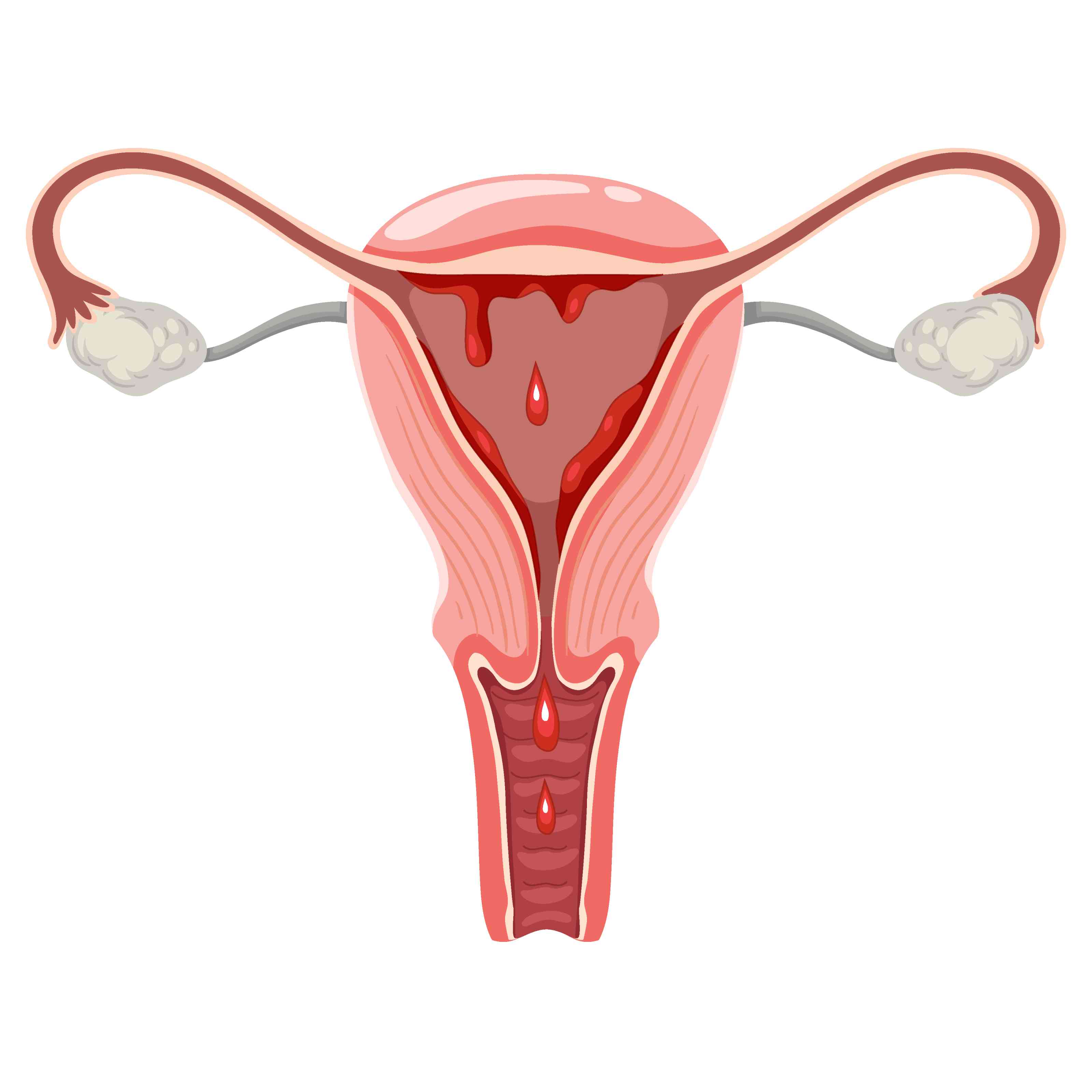 Uterine Bleeding Treatment