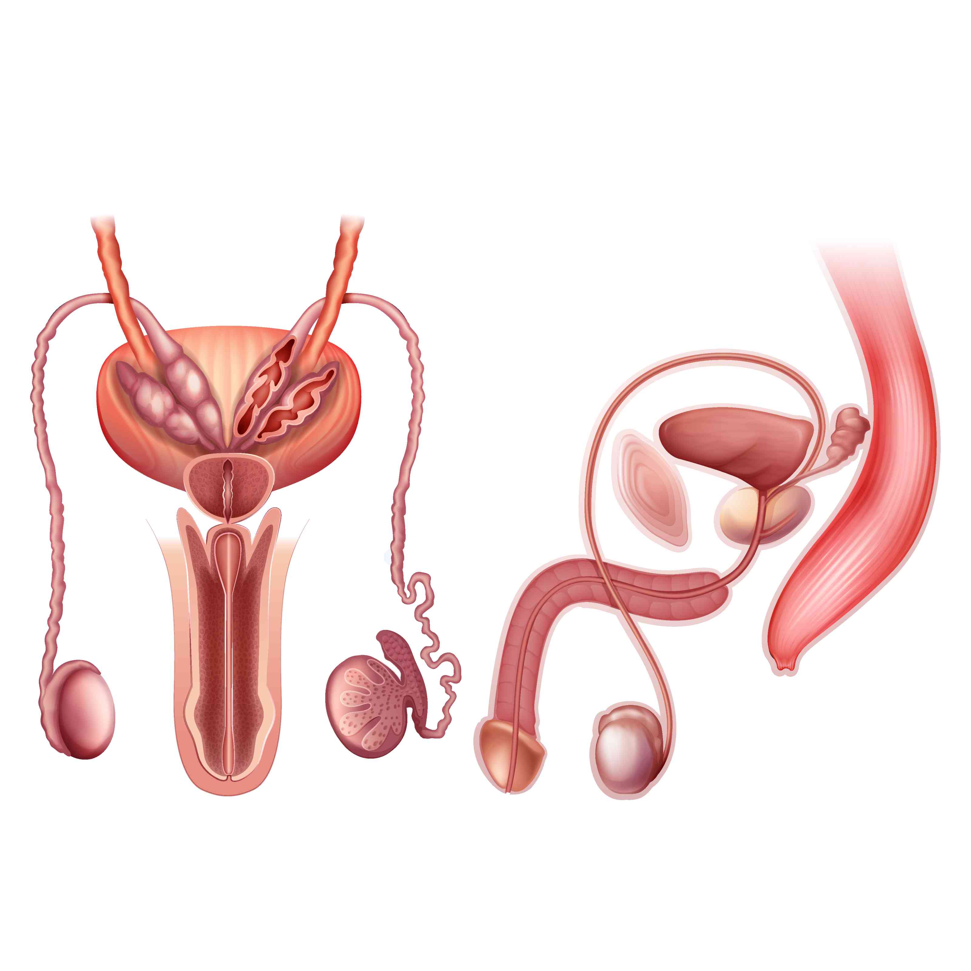Varicocele