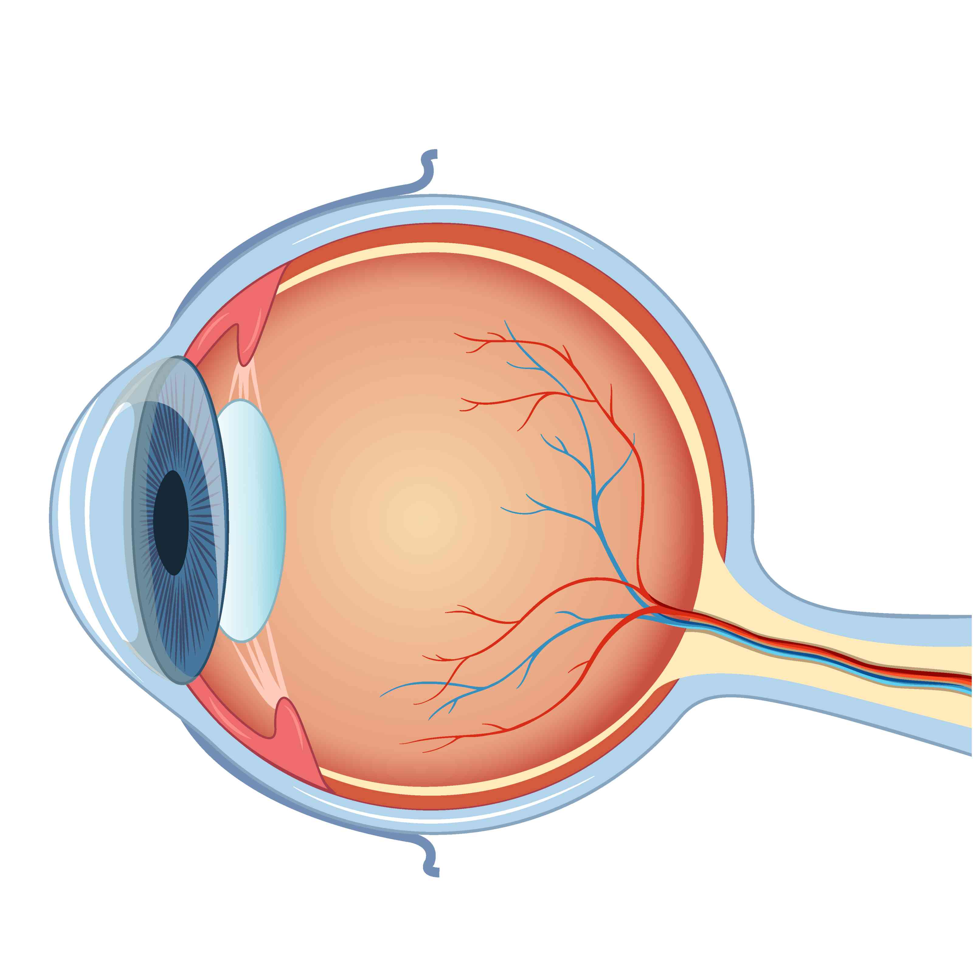Cataract